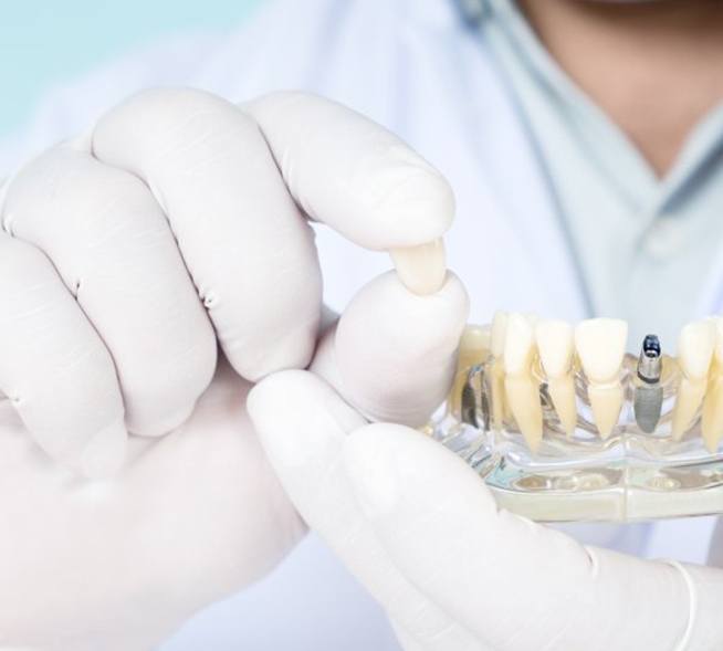 a dentist holding a model of a dental implant